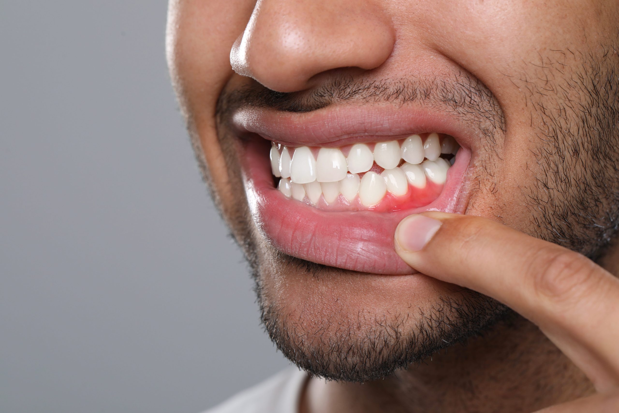 What Does Gingivitis Look Like?