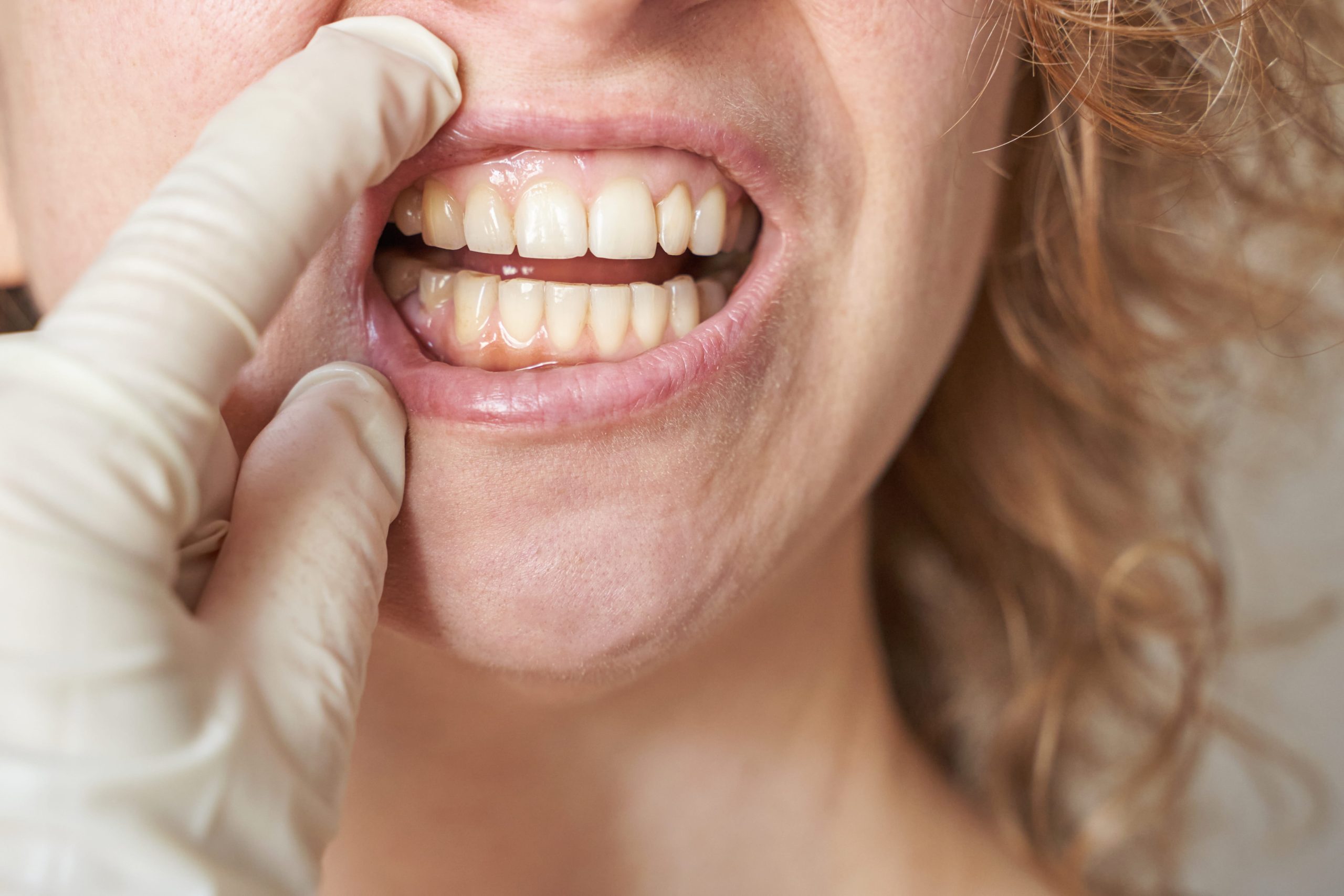 How to Fix Receding Gums?